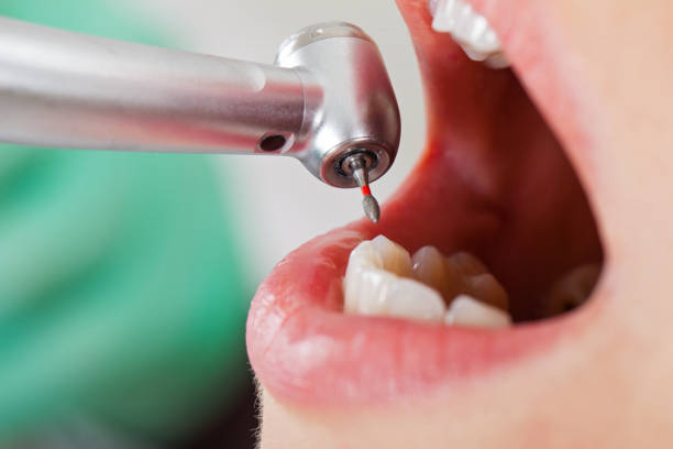 Best Broken or Cracked Tooth Emergency Dentist in East Hampton North, NY